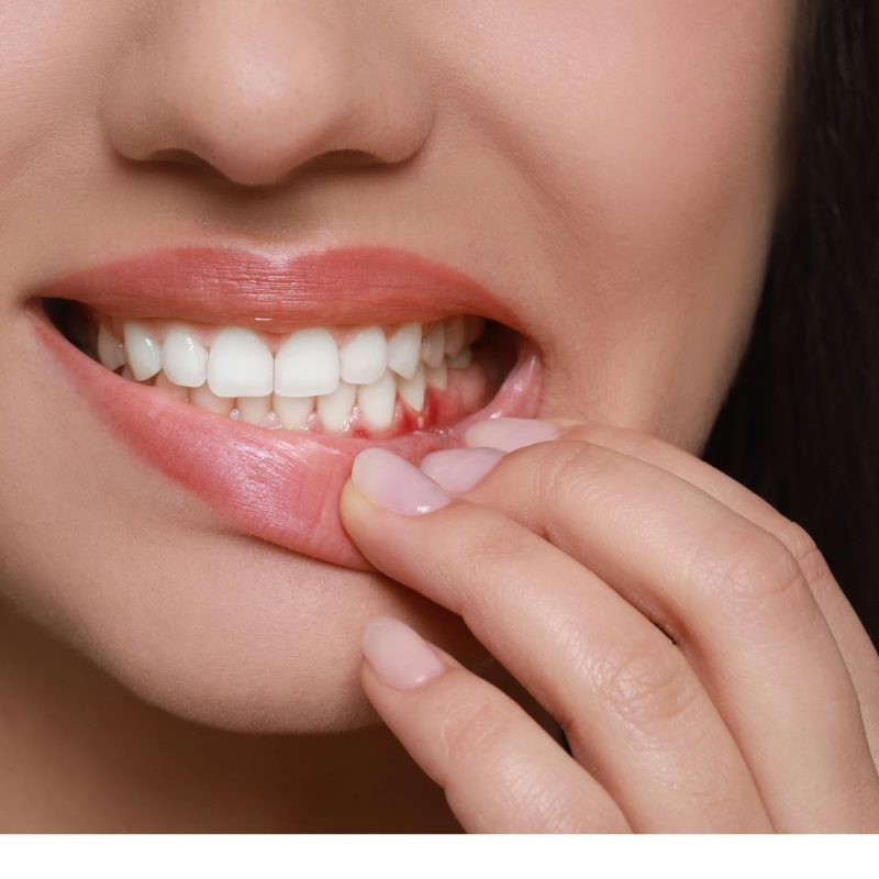 how to get rid of Gingivitis