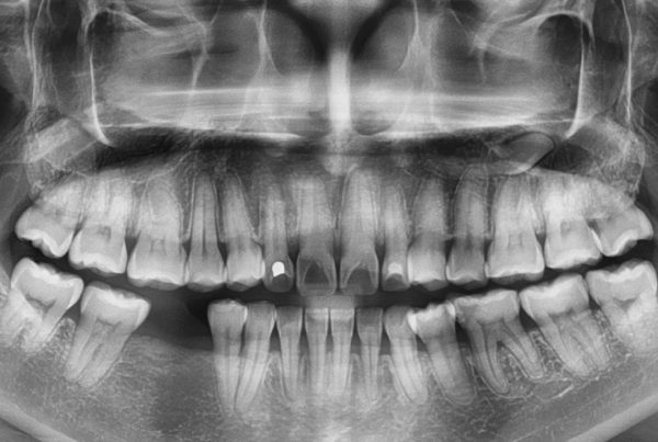 What Causes Dental Bone Loss?