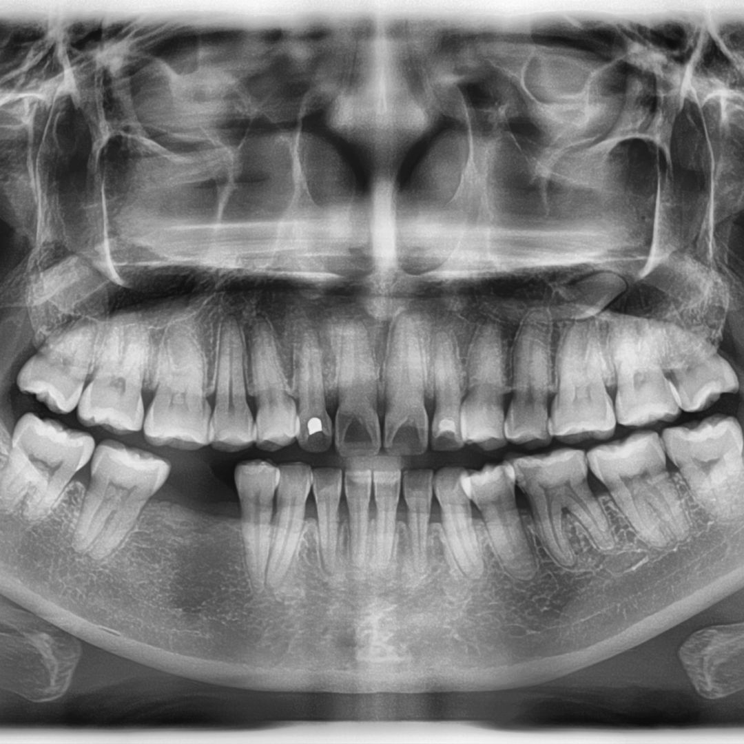 What Cause Dental Bone Loss