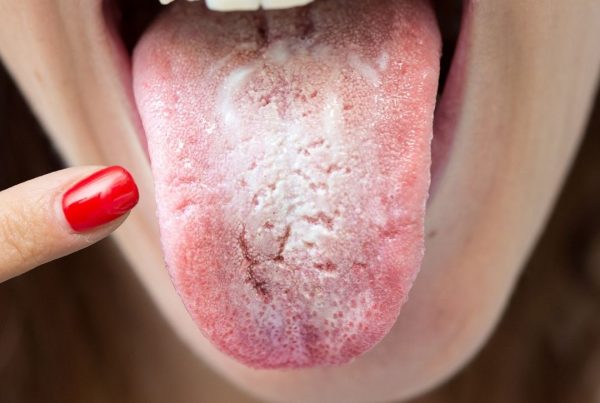The Role of Saliva in Preventing Dental Issues