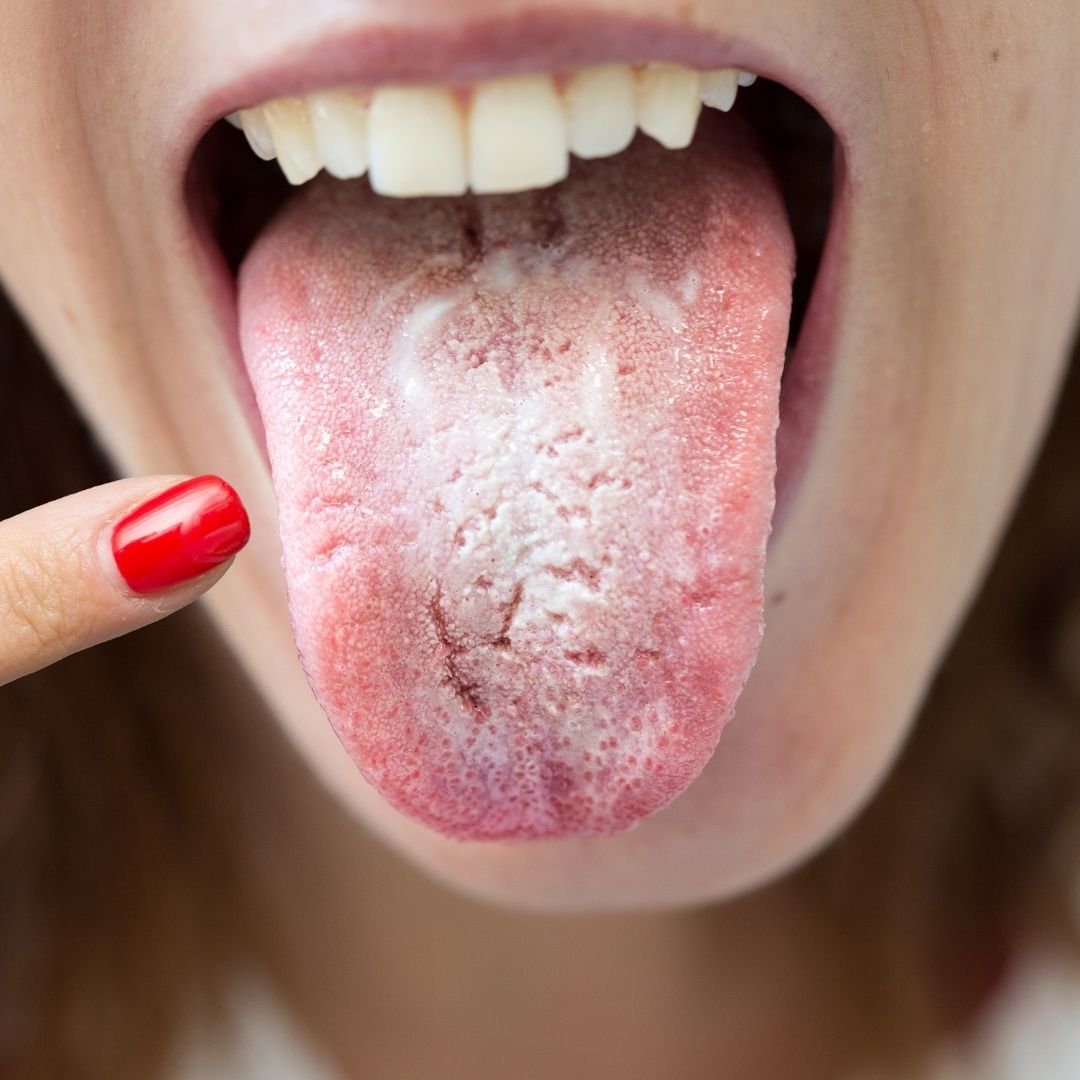 The Role of Saliva in Preventing Dental Issues