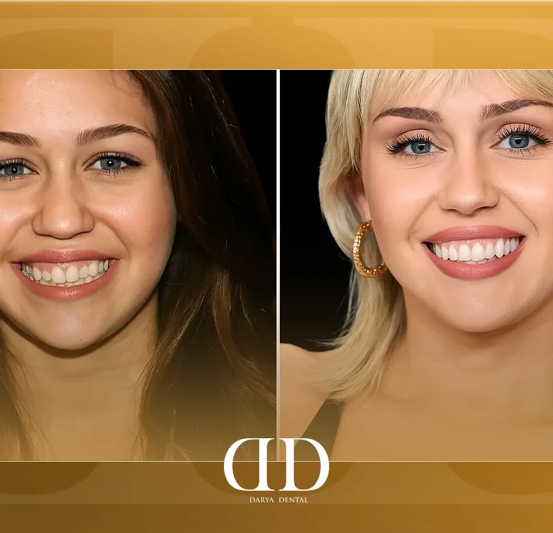 Miley Cyrus's teeth