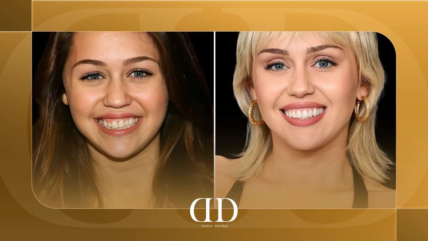 Miley Cyrus Teeth: Behind Her Hollywood Smile Transformation