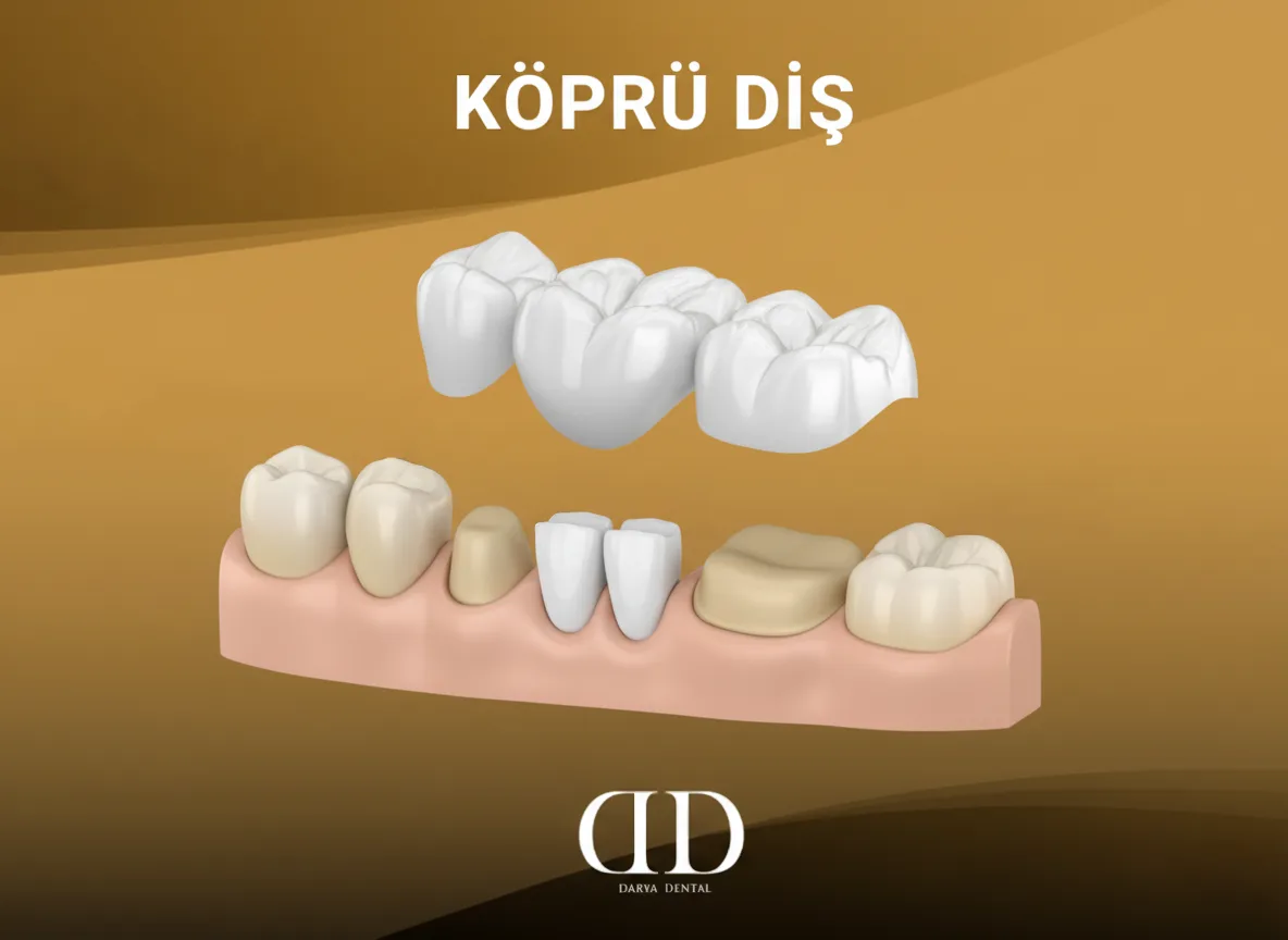 Köprü Diş: Eksik Dişlerinizi Tamamlamanın Etkili Yolu