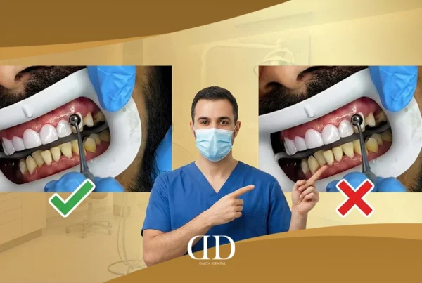 cosmetic composite bonding