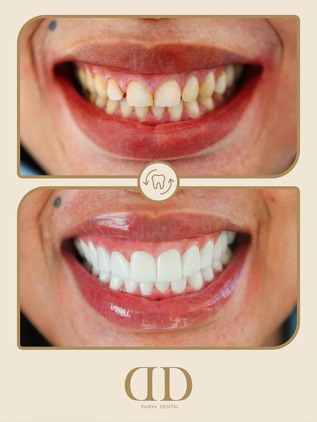 Khanyi Mbau teeth before after