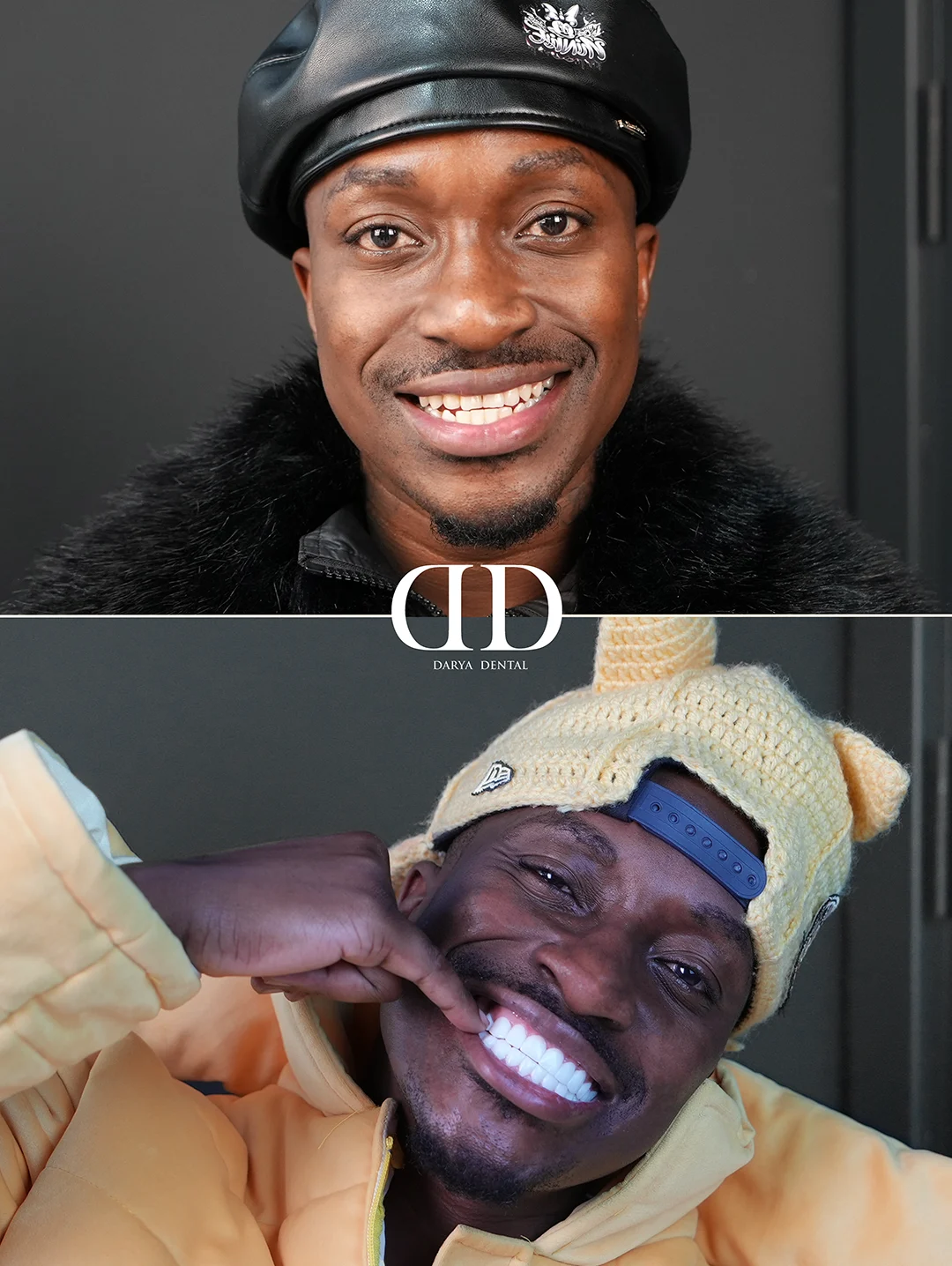 Bobby Blanco Teeth before after