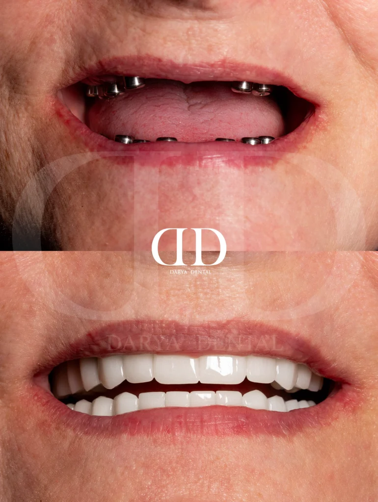 Bego implant dental turkey