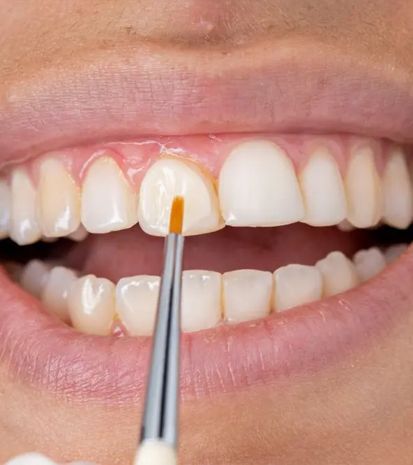 Composite bonding in Turkey