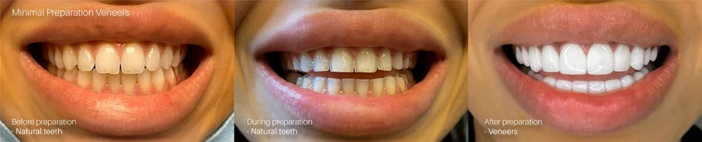 Veneers shaving procedure