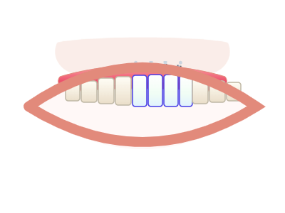 After All-on-4 Implants