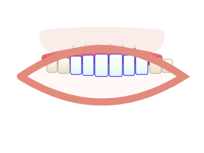 After All-on-6 Implants