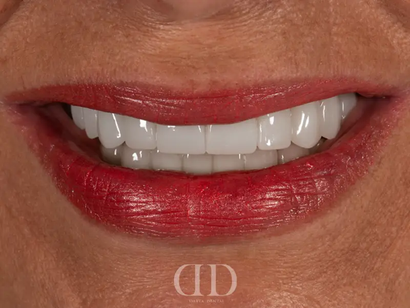 All-on-4 Dental Implants After Treatment