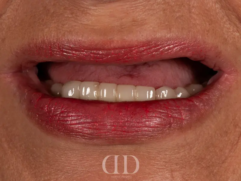 Jaw Before All-on-4 Dental Implant Treatment