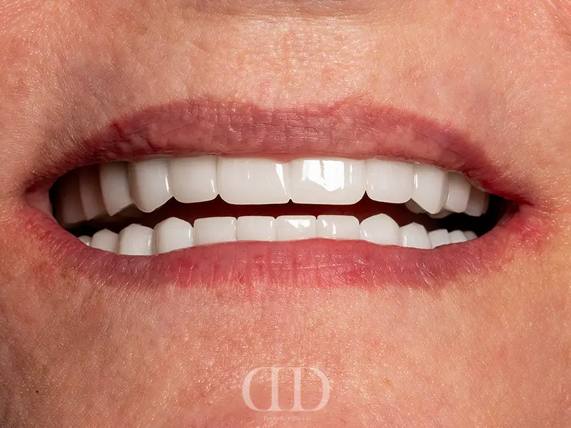 All-on-6 Dental Implants After Treatment