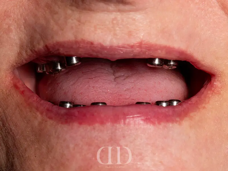 Jaw Before All-on-6 Dental Implant Treatment