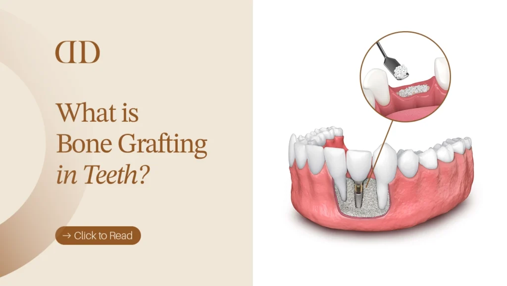 bone grafting