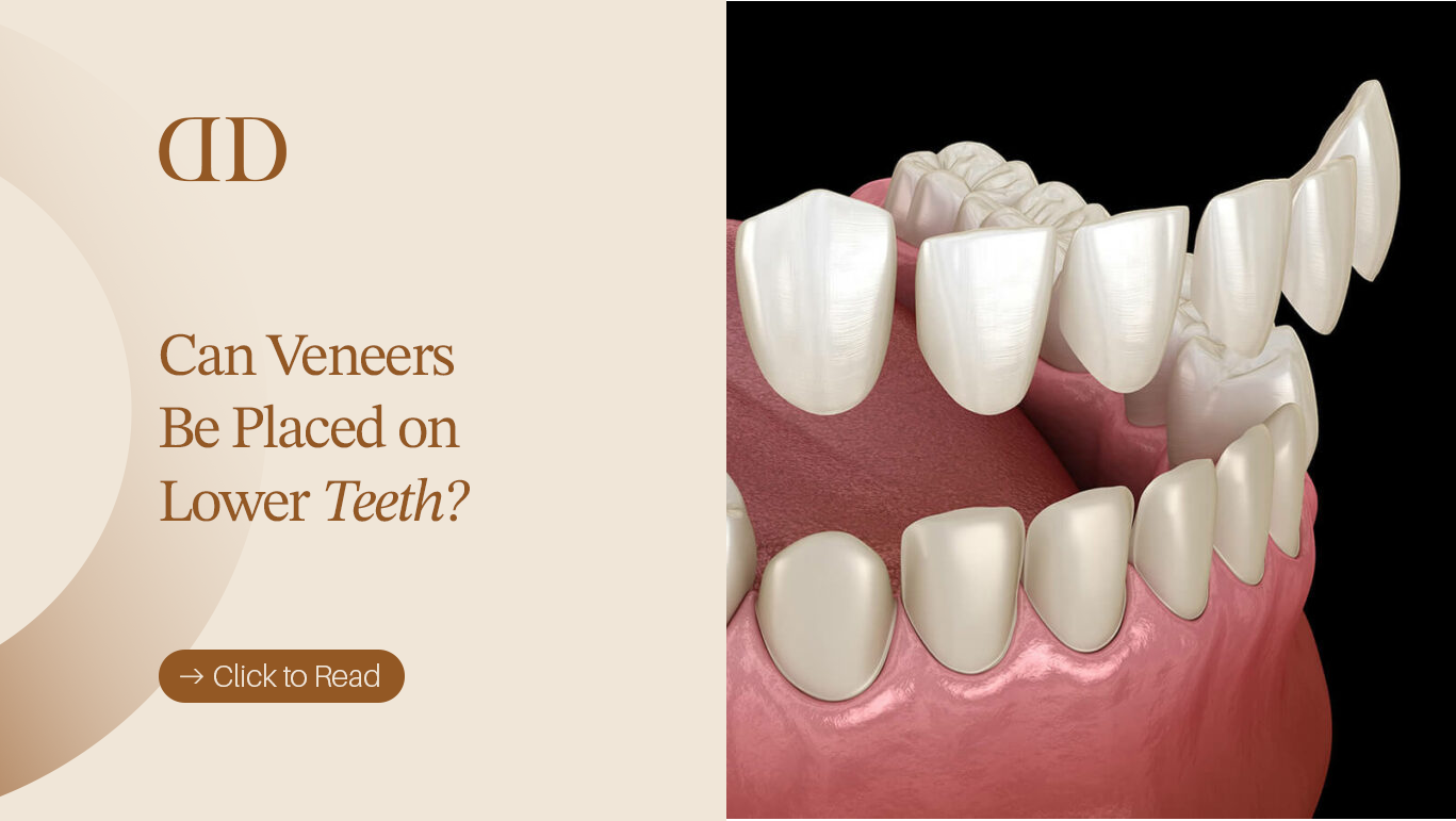 Can veneers be placed on lower teeth?