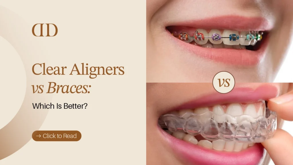 Clear Aligners vs Braces