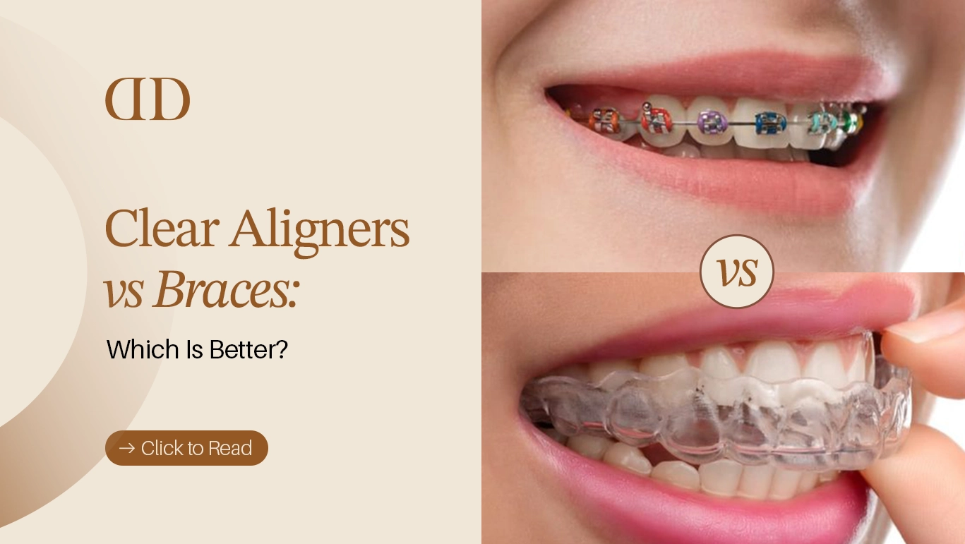 Clear Aligners vs Braces