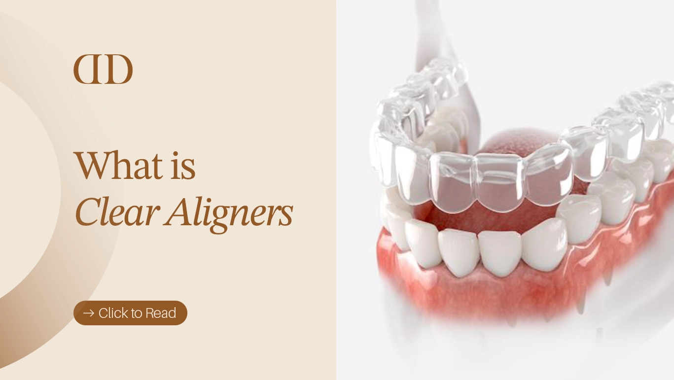 clear alinger