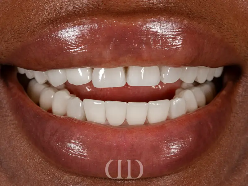 Composite Bonding After Treatment