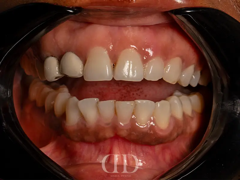 Teeth Before Composite Bonding Treatment