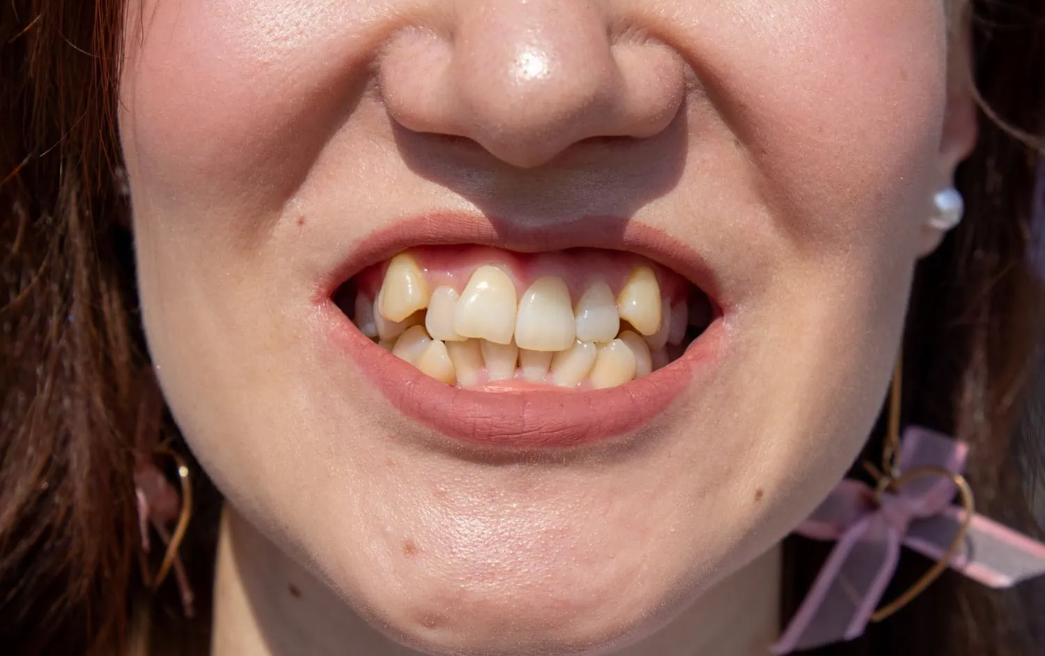 crooked teeth