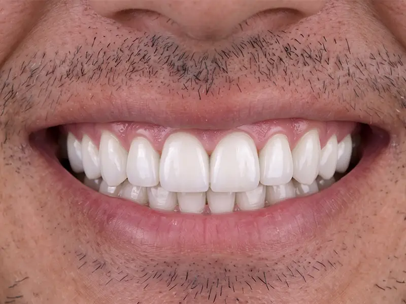 After Dental Bridge Treatment