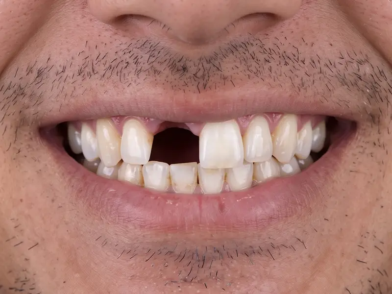 Before Dental Bridge Treatment