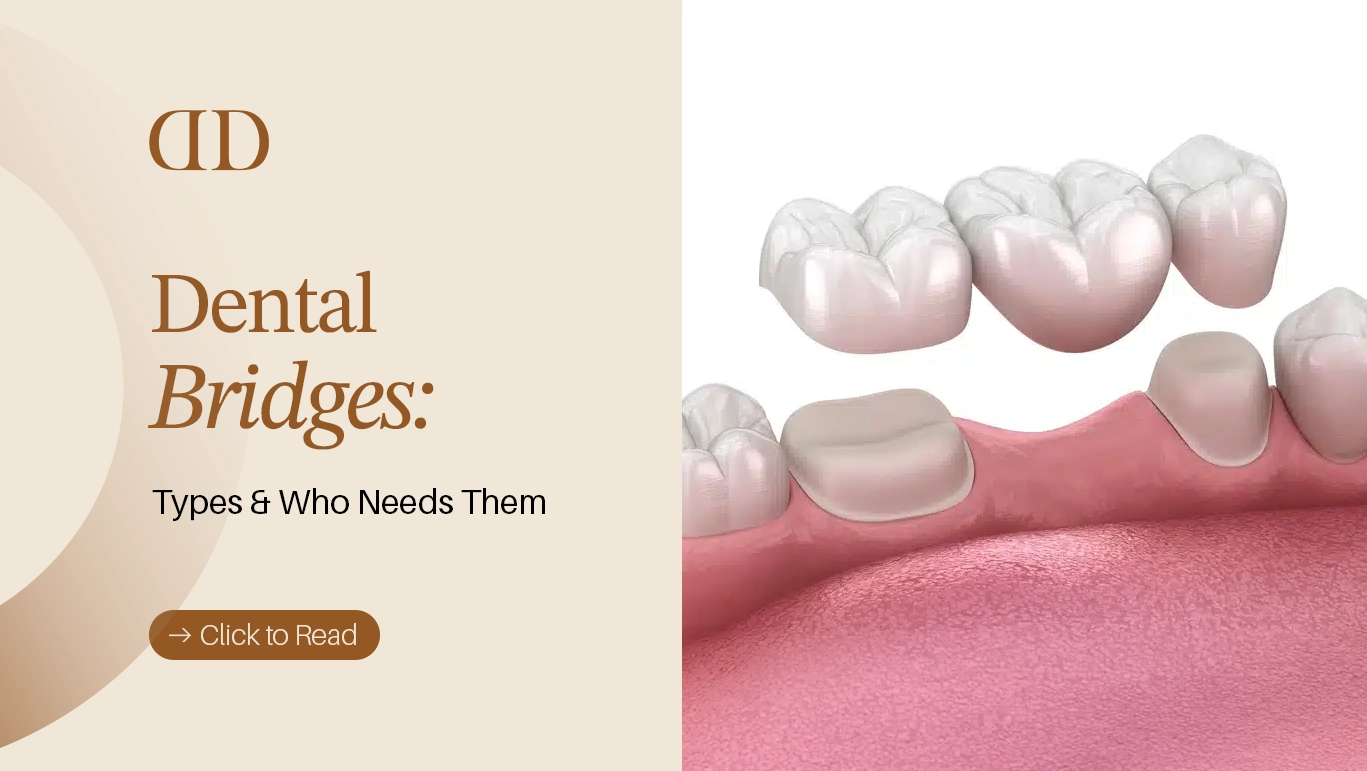 Dental Bridge