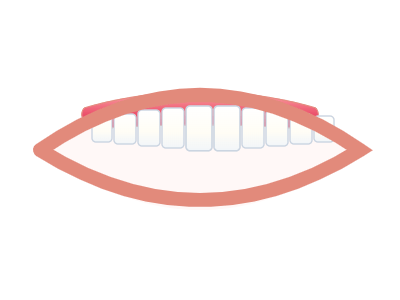 After Dental Cleaning