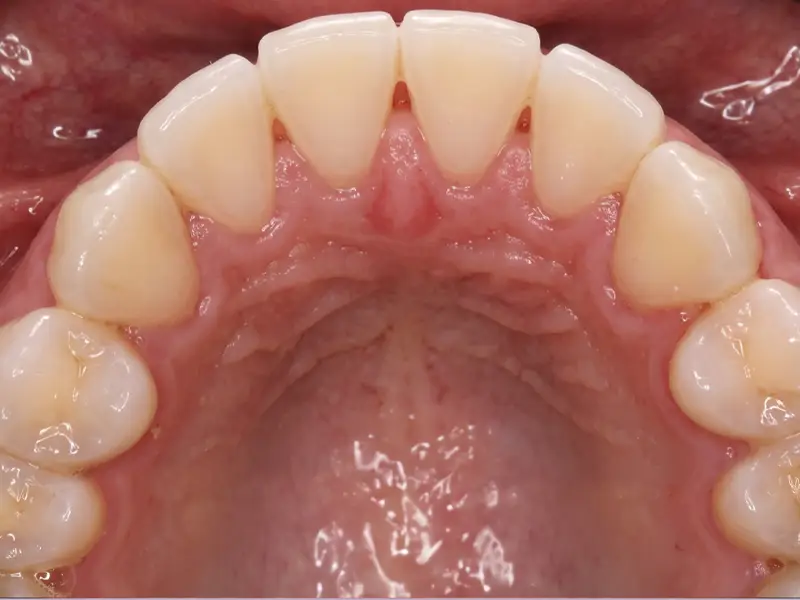 After Dental Cleaning