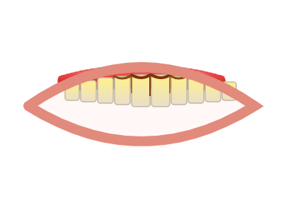 Before Dental Cleaning