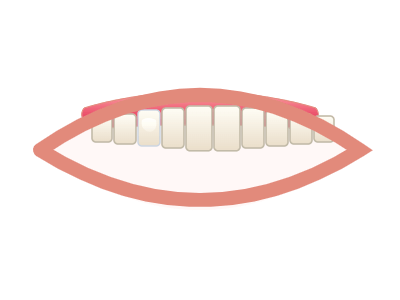 After Dental Fillings