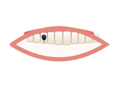 Before Dental Fillings