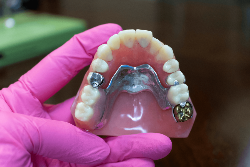 Dental flipper a removable temporary partial denture used to replace missing teeth