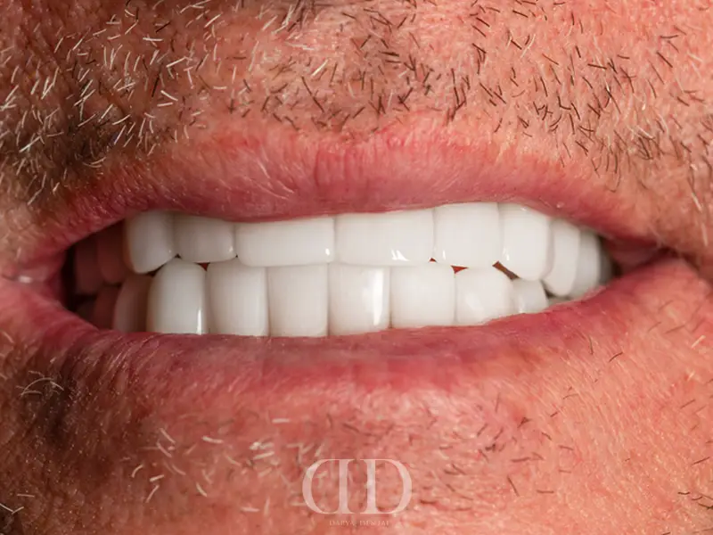 Dental Implant Treatment After