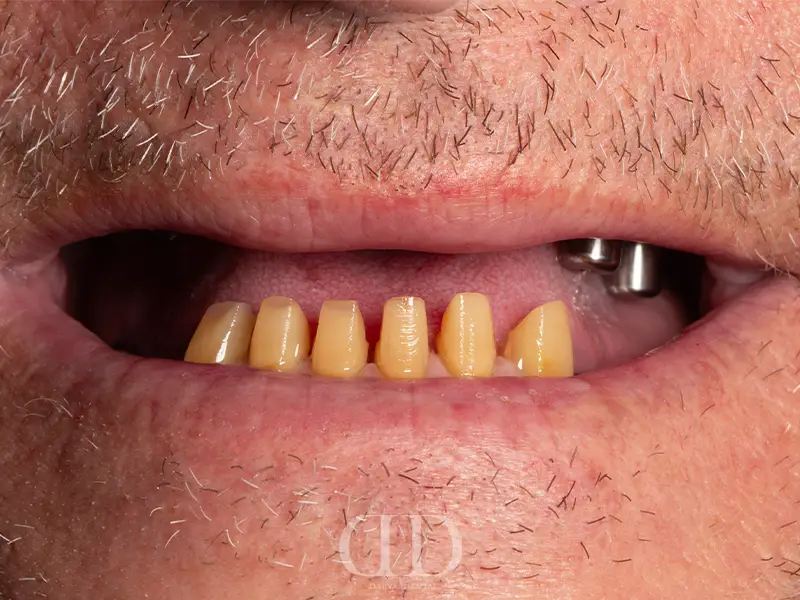 Dental Implant Treatment Before