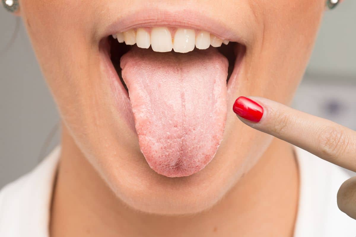 dry mouth