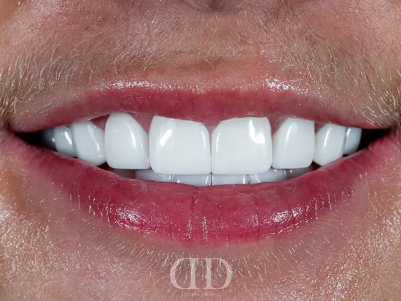 After E-Max crowns treatment