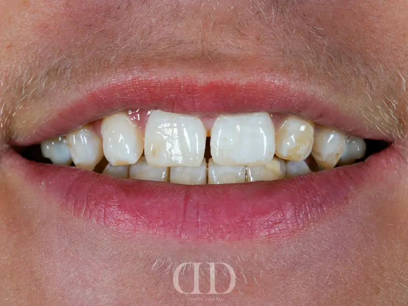 Before E-Max crowns treatment