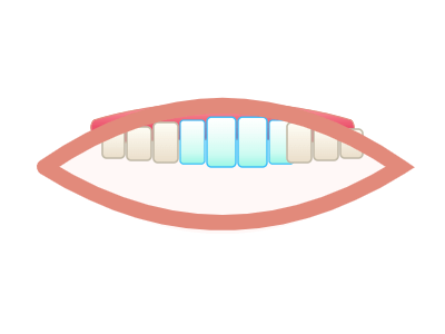 After E-Max Crowns