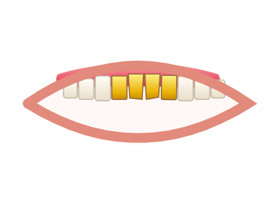 Before E-Max Crowns