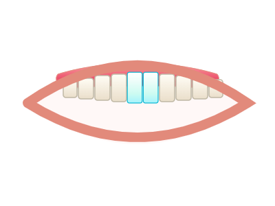 After E-Max Veneers