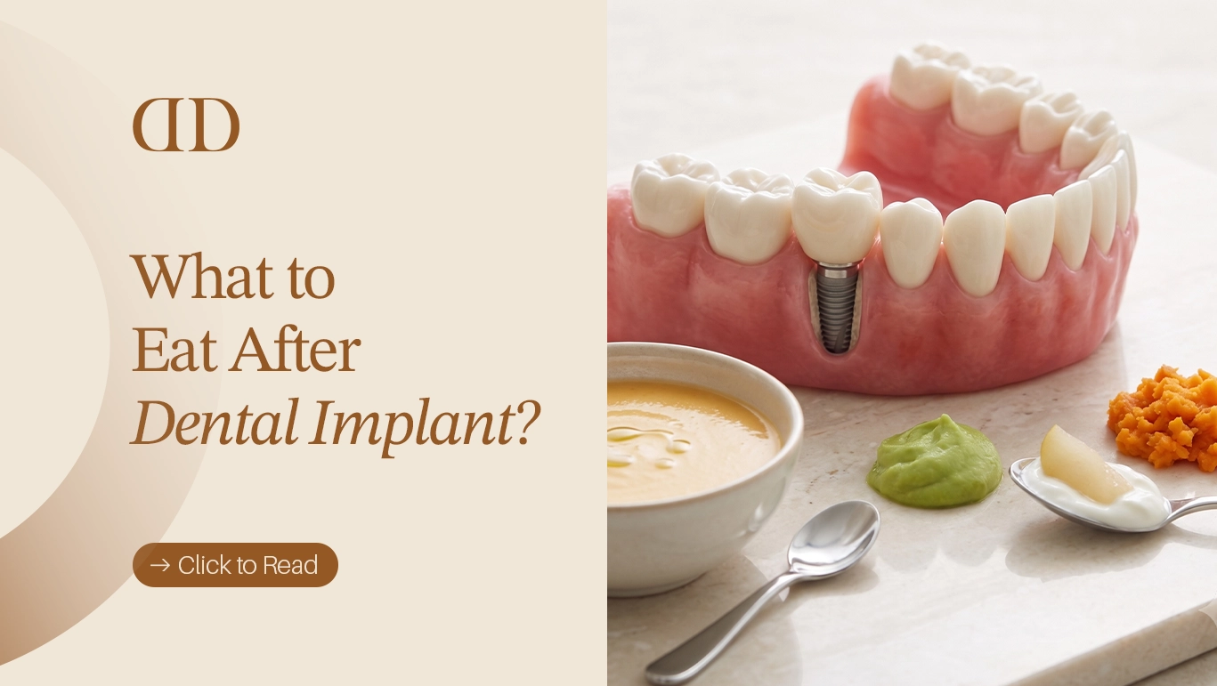 What to Eat After Dental Implant