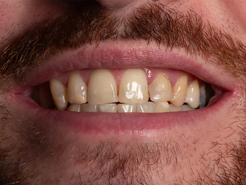 Teeth Before E-Max Veneers Treatment