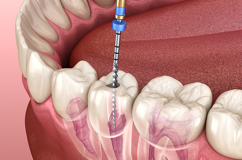 endodontics