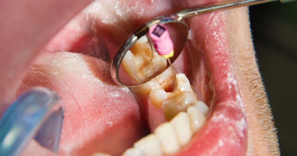 endodontics