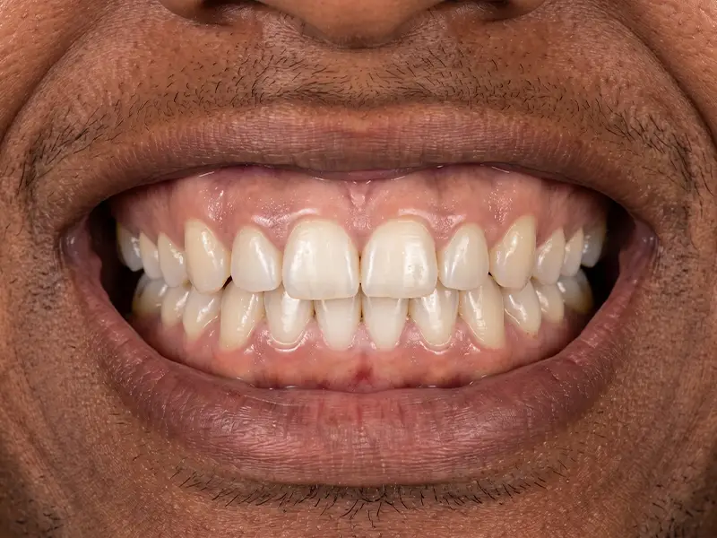 After gum bleaching